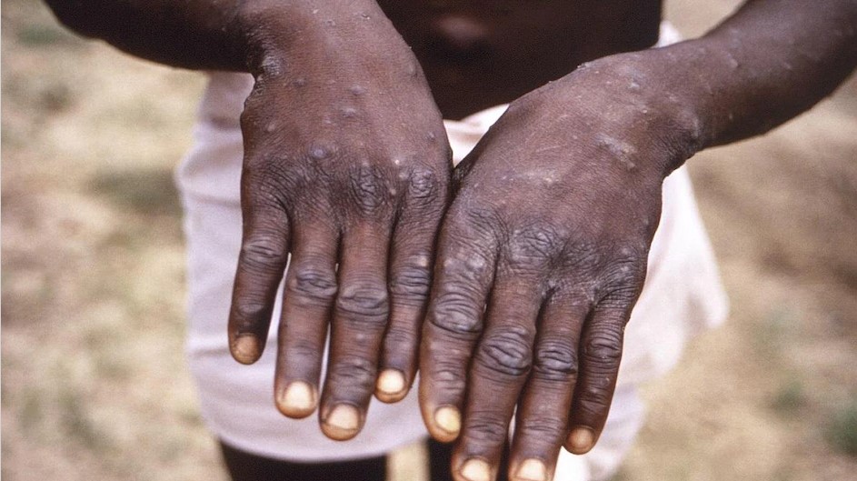 India's First Monkeypox Case Reported In Kerala