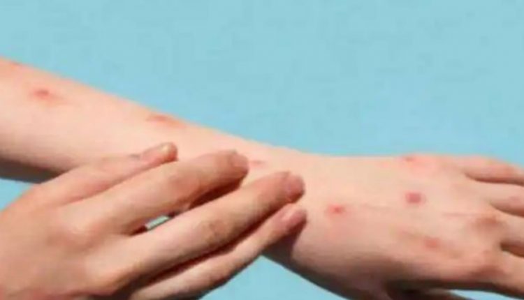 countrys-third-monkeypox-confirmed-in-kerala