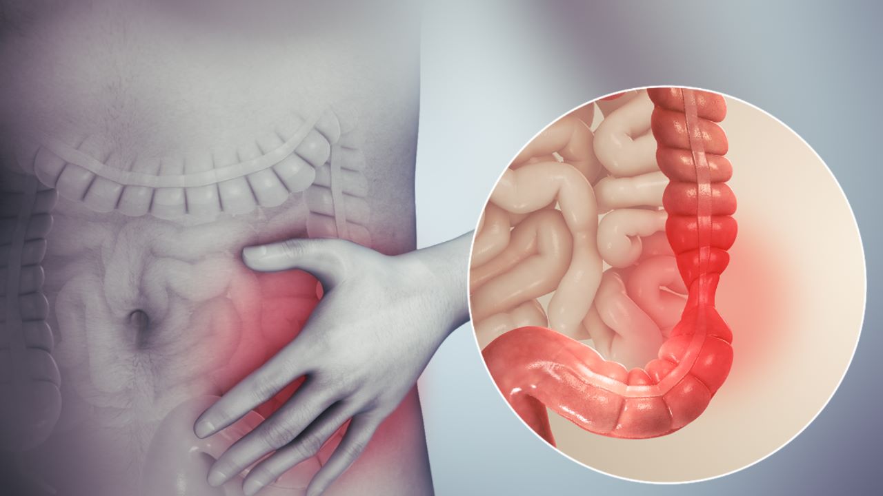 Doctor at KIMS Emphasizes Lifestyle Modifications in Managing Irritable Bowel Syndrome (IBS)