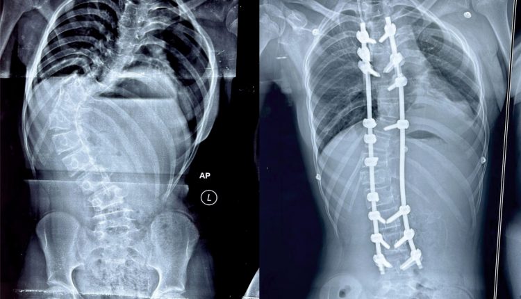 KIMS Doctors Achieve Breakthrough, Saves Young Girl’s Life with Complex Spine Surgery